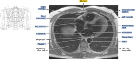 Mri Of The Heart Radiology Key