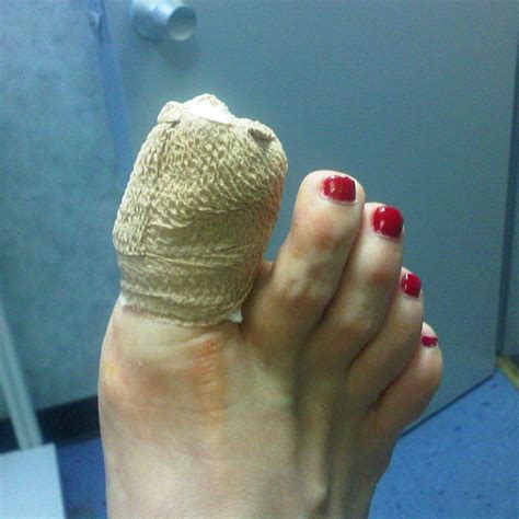 Runners Simple And Painful Ingrown Toenail Runnerclick