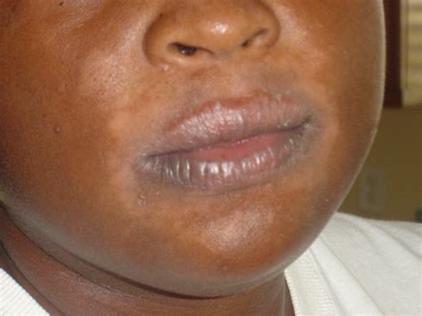 Common Causes Of Skin Discoloration Around The Mouth Heidi Salon