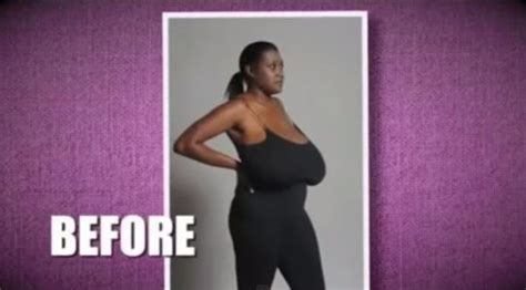 Woman With 36nnn Breasts Has Them Removed Because She Can T Run Or Jump Metro News