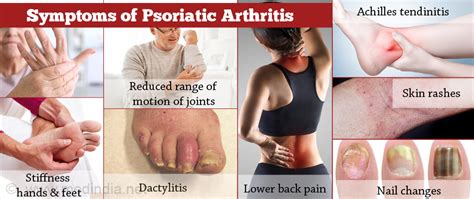 Psoriatic Arthritis Types Causes Risk Factors Diagnosis Treatment