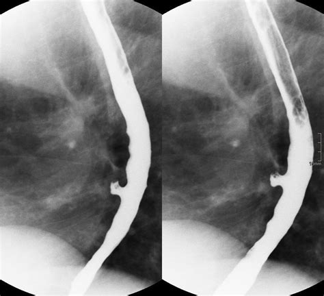 Pulsion Oesophageal Diverticulum Radiology Case