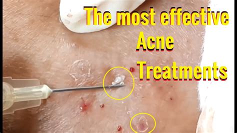 Milia Acne Treatment Blackheads Removal 24 Rid Of Acne Youtube