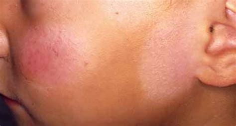 Specifically, pityriasis versicolor appears more when one is suntanned. White Patches on Face - Pictures, Causes, Fungus, Treat ...