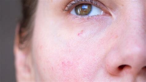 What To Do About Broken Blood Vessels On Your Skin
