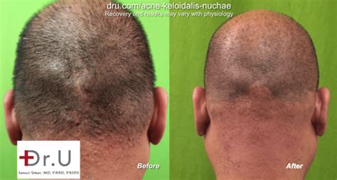 Video Laser Treatment For Bumps On Back Of Head By Dr U