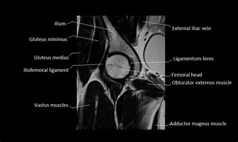 A magnetic resonance imaging (mri) was performed on a cross section of the foot with anatomical structures labeled as arteries, muscles. anatomy of hip joint | free MRI coronal cross sectional ...