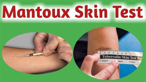 Mantoux Test Tuberculin Skin Test Tuberculin Test YouTube