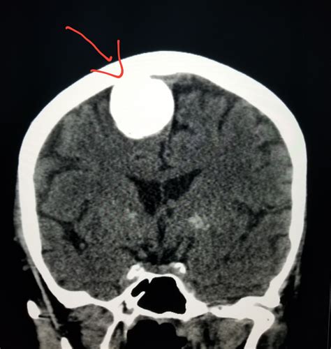 A growing tumor eventually will compress and damage other structures in the brain. Pin on CT Scans