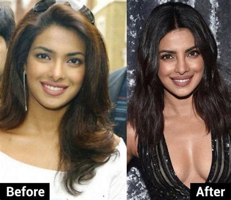 Before And After Pics Of Celebs Plastic Surgery