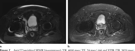 Figure 19 From Fat Suppression Techniques For 3 T Mr Imaging Of The