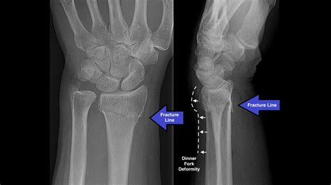 Lateral Wrist X Ray Labeled