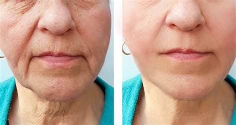Botox Marionette Lines An Anti Wrinkle Treatment Treatment