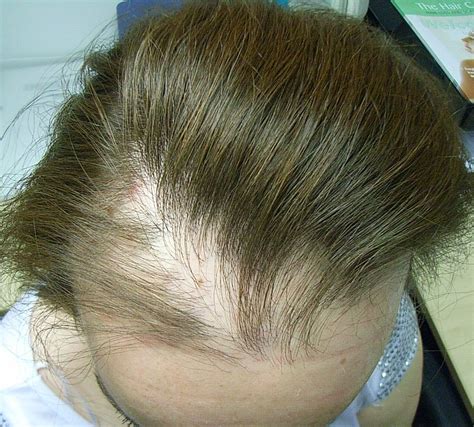 The Hair Loss Centre More Photos Of Female Hair Loss Treated Successfully