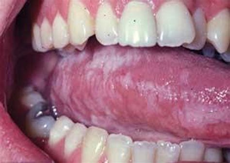 Oral Hairy Leukoplakia Registered Dental Hygienist Rdh Magazine