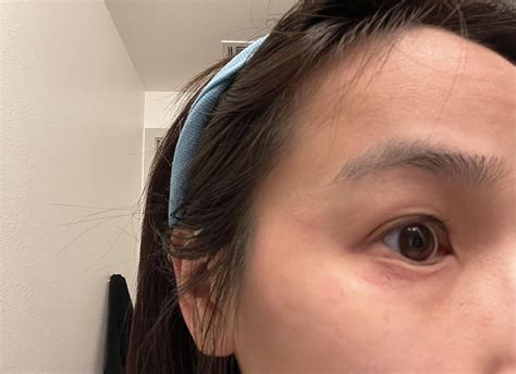 Skin Concerns Dry Flaky Patches On Forehead And Left Side Of Face