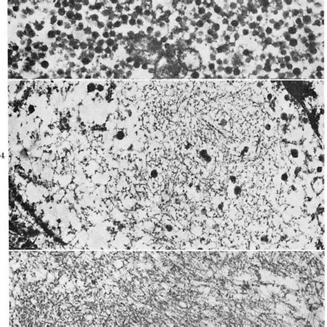 Some Nests Of Epithelioid Cells With Finely Granular Cytoplasm