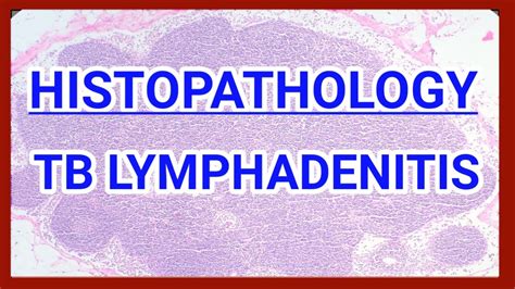 Tuberculous Lymphadenitis Histopathology Lymphnode Tuberculosis
