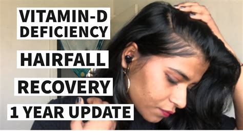 Vitamin D Deficiency Recovery 1 Year Update Hairfall Update Awareness Youtube