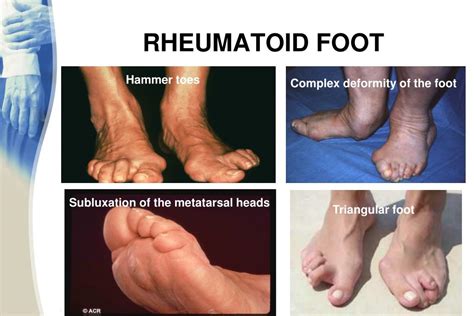 Ppt Rheumatoid Arthritis Ra Powerpoint Presentation Free Download