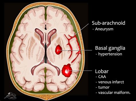 Deep Intracerebral Hemorrhage Pictures Hot Sex Picture
