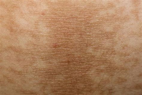 The 101 On Acanthosis Nigricans Coast Dermatology And Skin Cancer Center