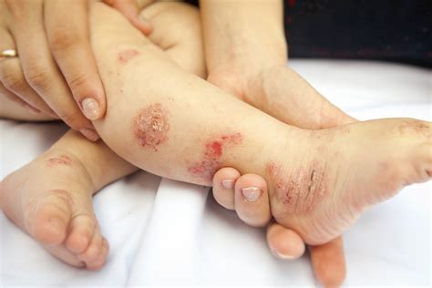 Dermatite Atópica Causas Sintomas E Tratamentos Dicas De Saúde