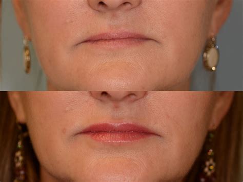 Botox And Facial Fillers For Rejuvenation Houston Tx