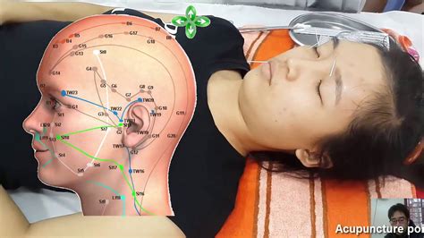 Acupuncture Paralysis State 12 On The Face Caused By A Cold Paralell Nerve 7 Peripheral
