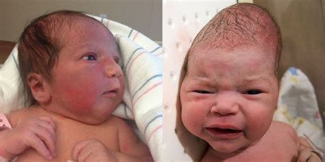 Unbelievable Birth Photos That Show What Can Happen To The Babys Head
