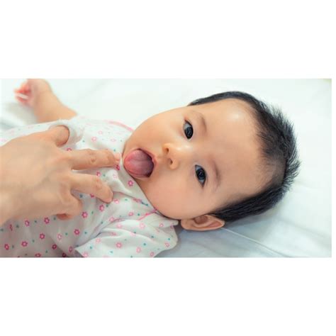 tongue tie rimrock pediatric dentistry