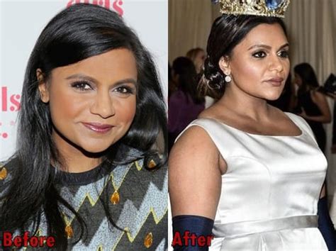 Mindy Kaling Plastic Surgery Before And After Photos