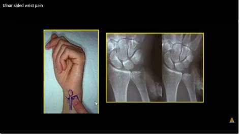 Ulnar Sided Wrist Pain Orthopaedicprinciples Com