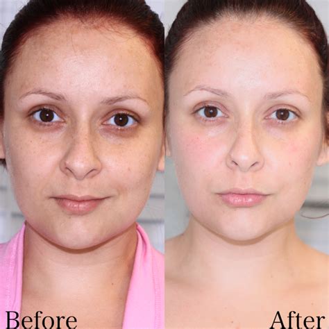 Top 98 Pictures Microdermabrasion Before And After Pictures Sharp