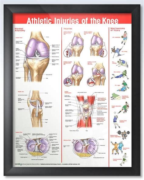 Athletic Injuries Of The Knee Chart 20x26 In 2020 Athletic Injuries