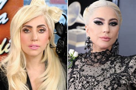 Lady Gaga Face Lift Plastic Surgeon Gives Verdict On Singers Dramatic Transformation Daily Star