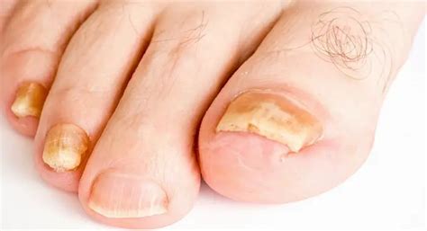 What Causes Yellow Toenail Fungus How To Get Rid Of It