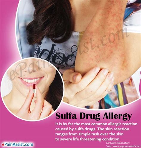 Sulfa Drug Allergy Symptoms Diagnosis Treatment Management Meds To Avoid