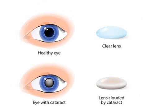 X Cataracts Applecross Eye Clinic