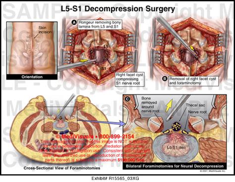 L5 S1 Decompression Surgery Medical Exhibit Medivisuals