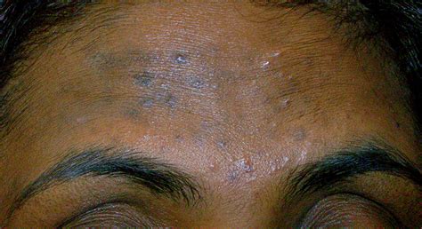 Recognising Common Skin Conditions In People Of Colour The