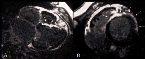 Figure 2 from Realce tardío del gadolinio en la miocardiopatía no