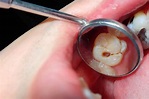 Tooth Decay: Stages, Complications, and Treatment
