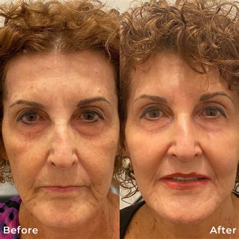 What Is Phoenix 15 Co2 Fractional Laser Resurfacing Rejuvayou Medical