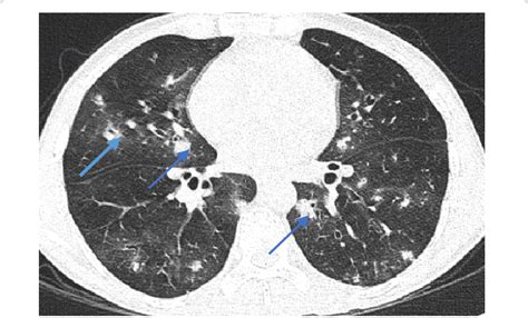 High Resolution Computed Tomography Hrct Thorax 190216 Revealed