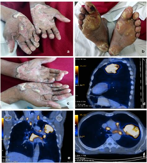 Squamous Cell Carcinoma Of Lung Associated With Rare