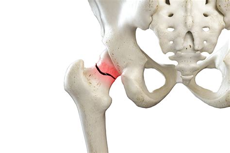 Should You Repair A Fractured Hip Or Replace A Fractured Hip An Tâm