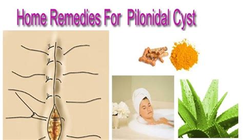 Home Remedies For Pilonidal Cysts Yabibo