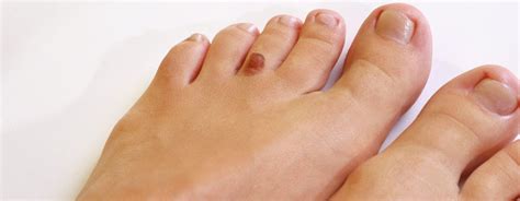 Melanoma Of The Foot Orange County Foot And Ankle Doctor