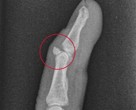 Avulsion Fracture What It Is Causes Symptoms Treatment And Recovery